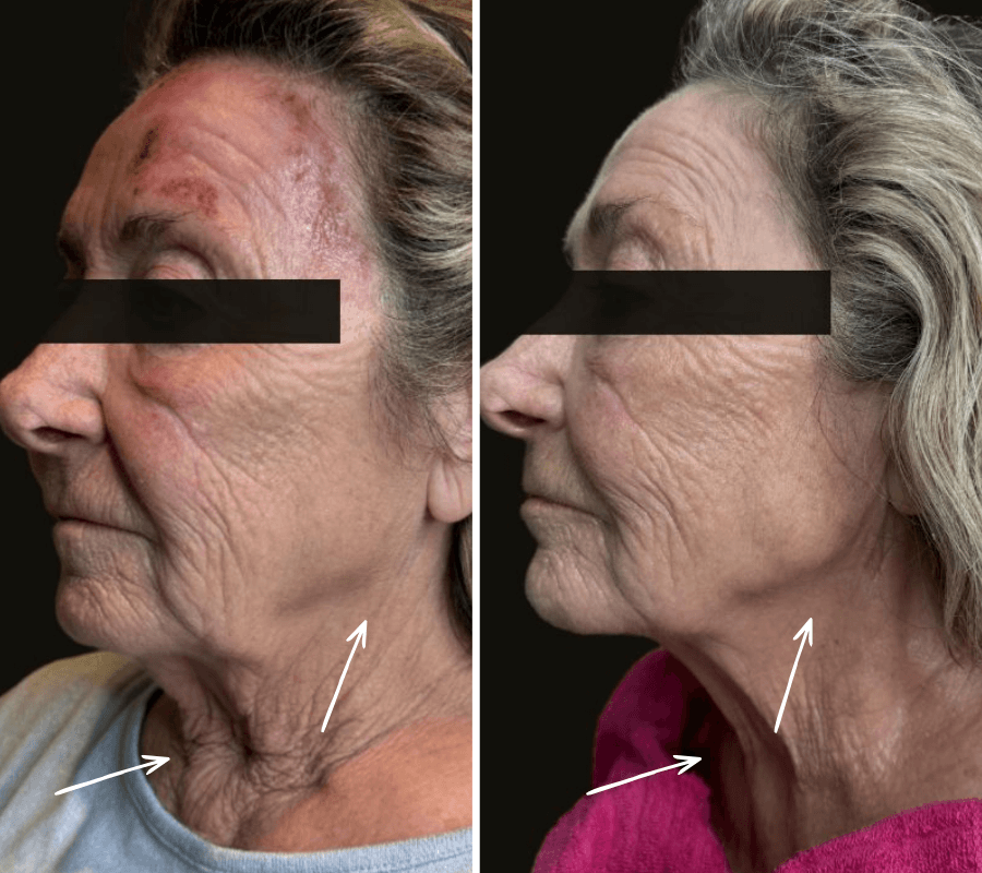 Comblement visage