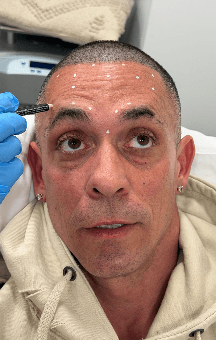 Traitement botox Éclat Aven