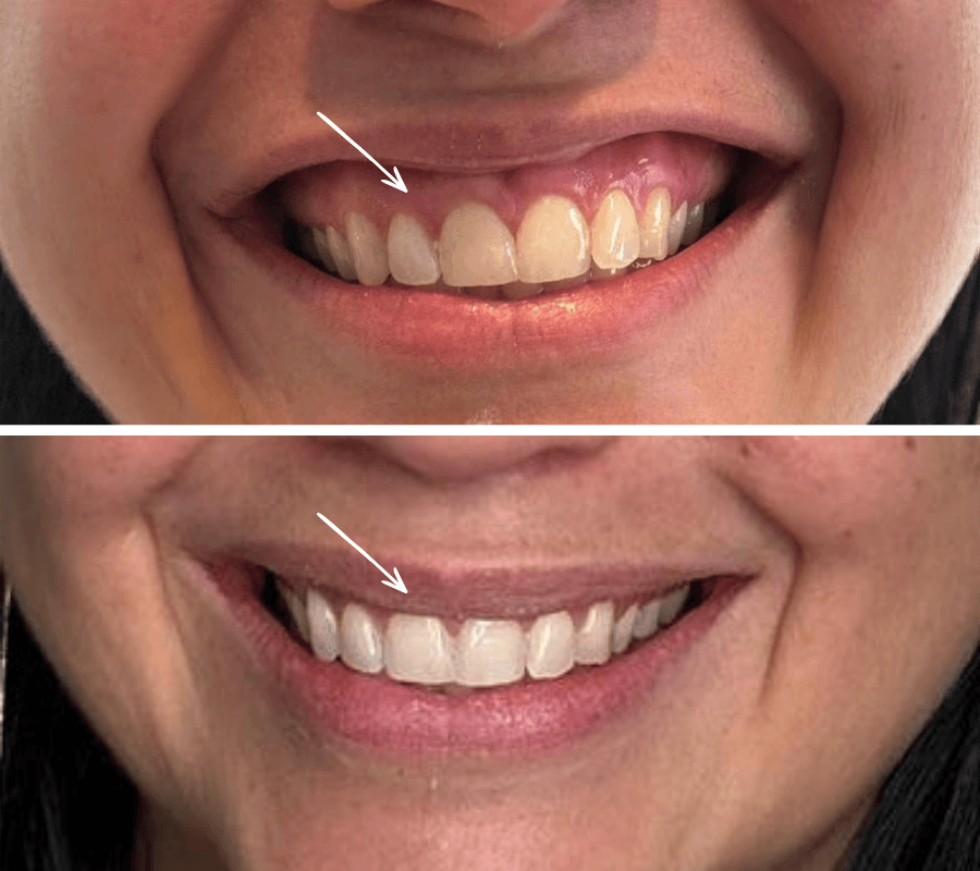 Gummy smile