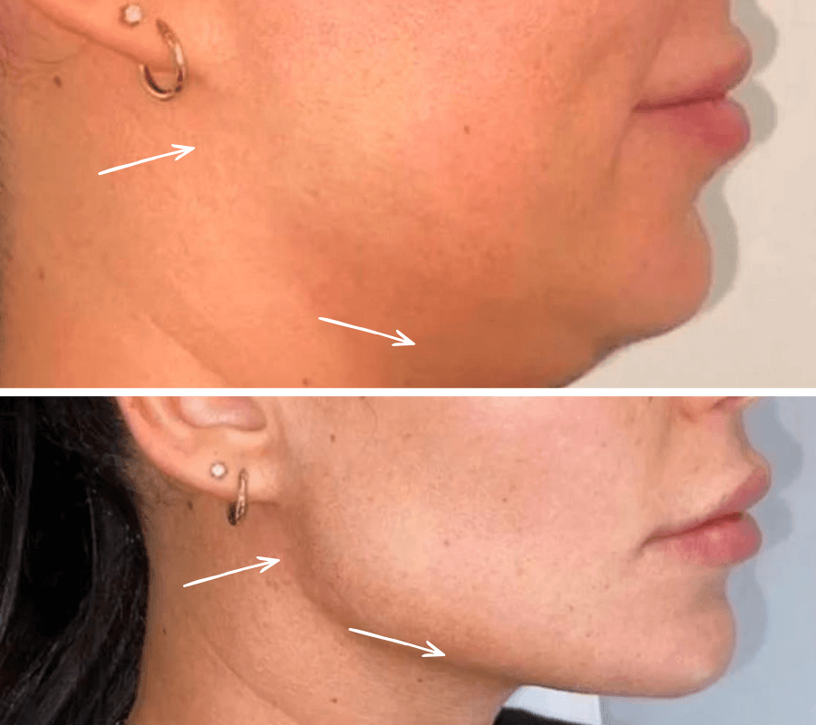 Lipolyse